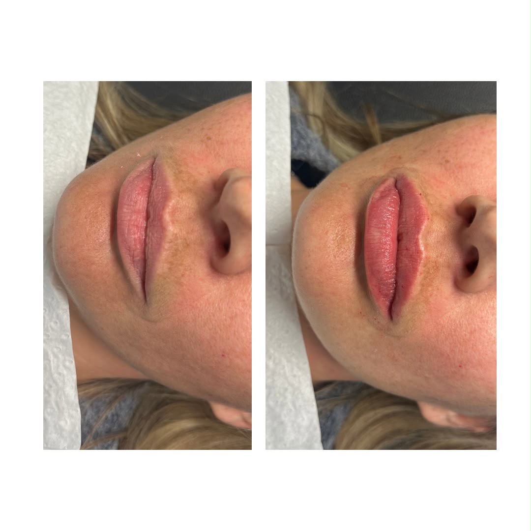 Lip treatment result